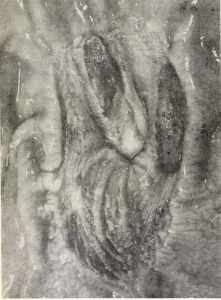 A pars oesophagica szélén és a nyálkahártya-ráncok élén helyeződő körülírt fekélyek